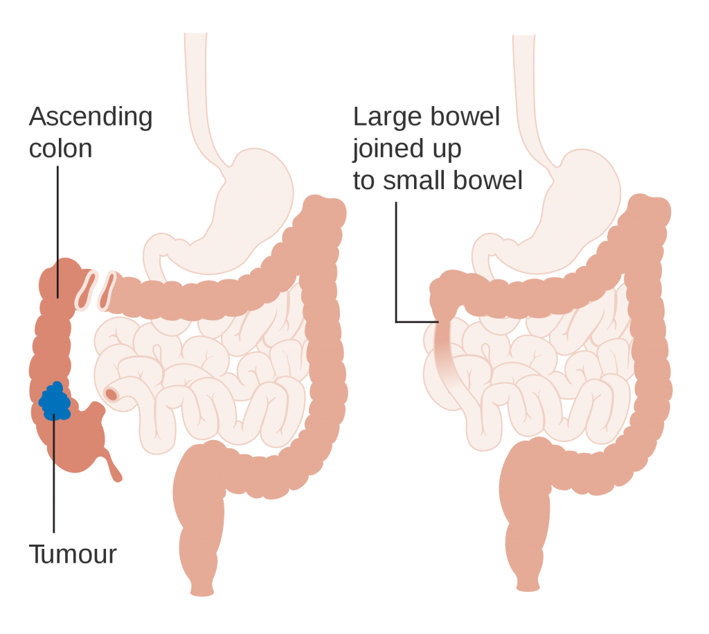 Gazy jelitowe czym są, skąd się biorą Mamandi.pl