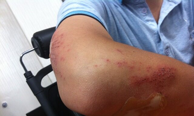 Czy siniaki po hula hop są niebezpieczne?